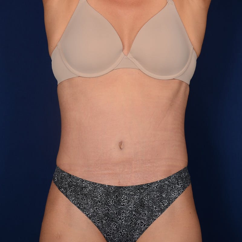 Severe Diastasis Recti Before & After Gallery - Patient 326953 - Image 2