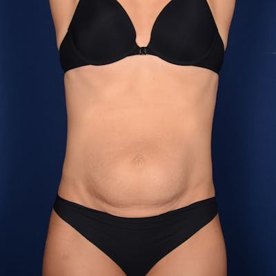 Tummy Tuck Before & After Gallery - Patient 287903 - Image 1