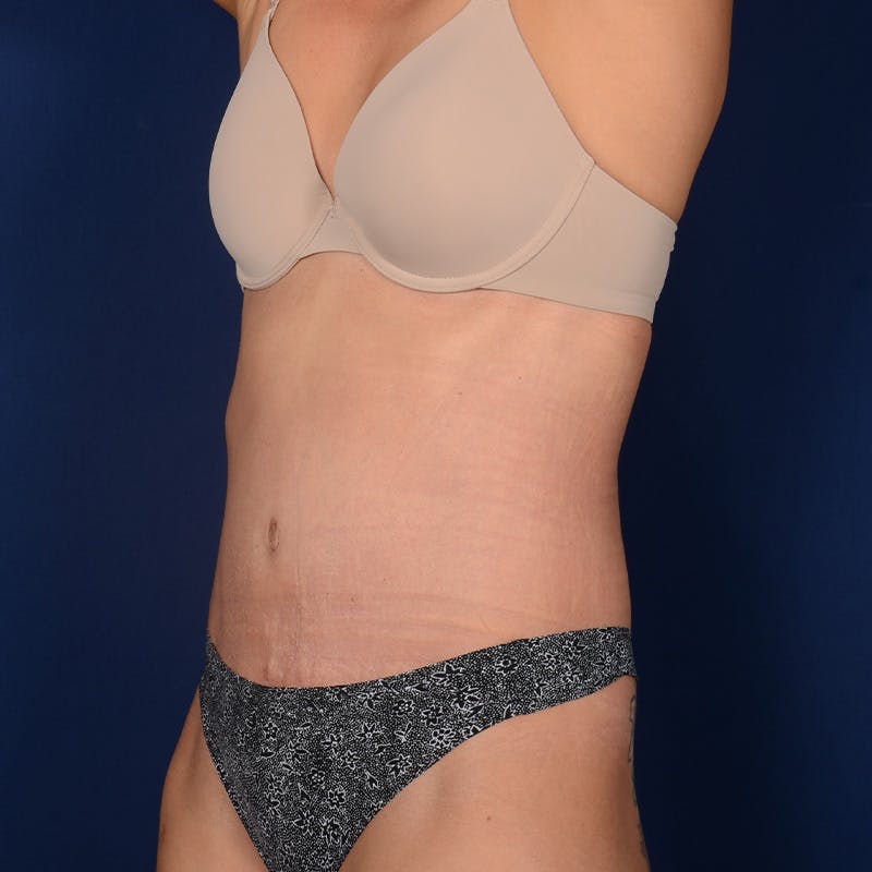 Severe Diastasis Recti Before & After Gallery - Patient 326953 - Image 4