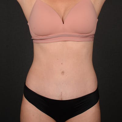 Tummy Tuck Before & After Gallery - Patient 418394 - Image 2