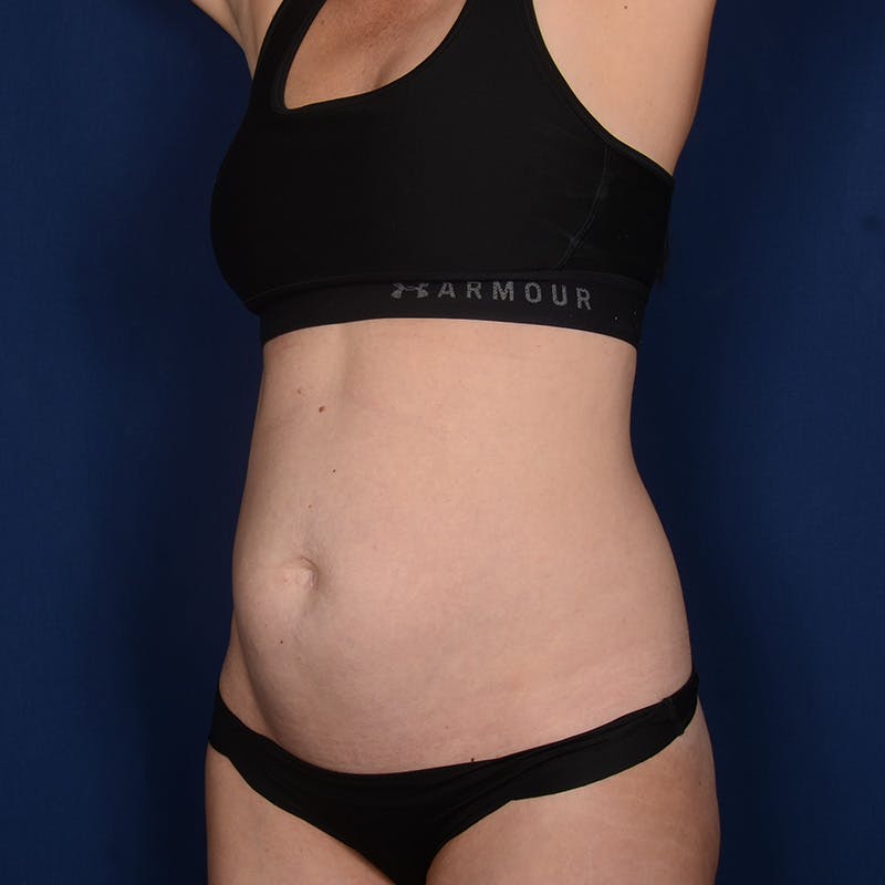 Tummy Tuck Before & After Gallery - Patient 418394 - Image 3