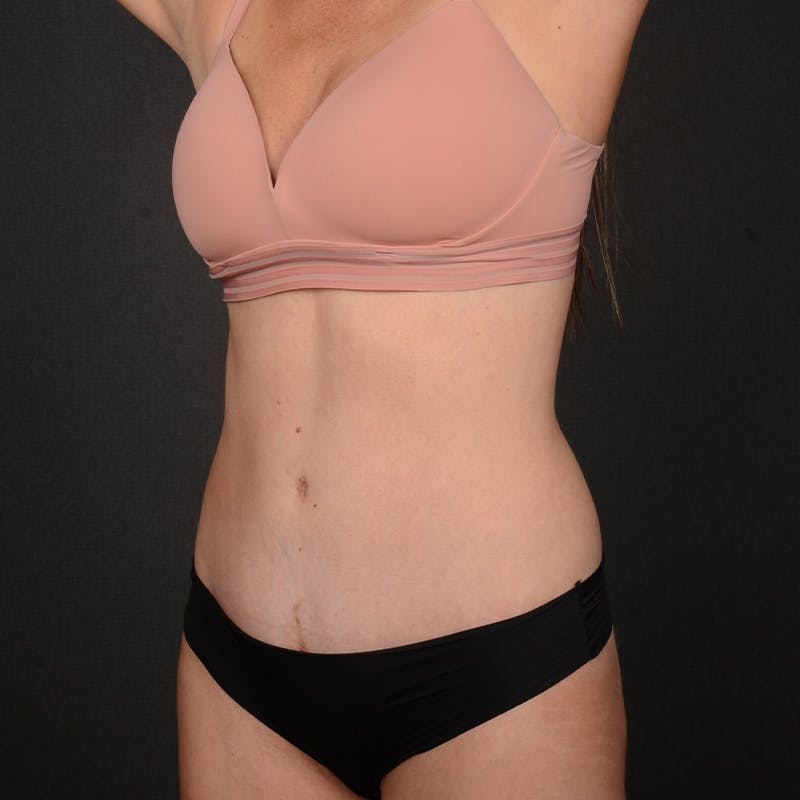 Tummy Tuck Before & After Gallery - Patient 418394 - Image 4