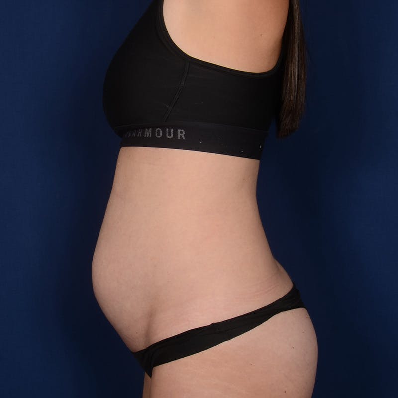 Tummy Tuck Before & After Gallery - Patient 418394 - Image 5