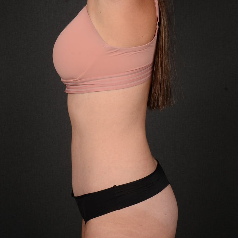 Tummy Tuck Before & After Gallery - Patient 418394 - Image 6