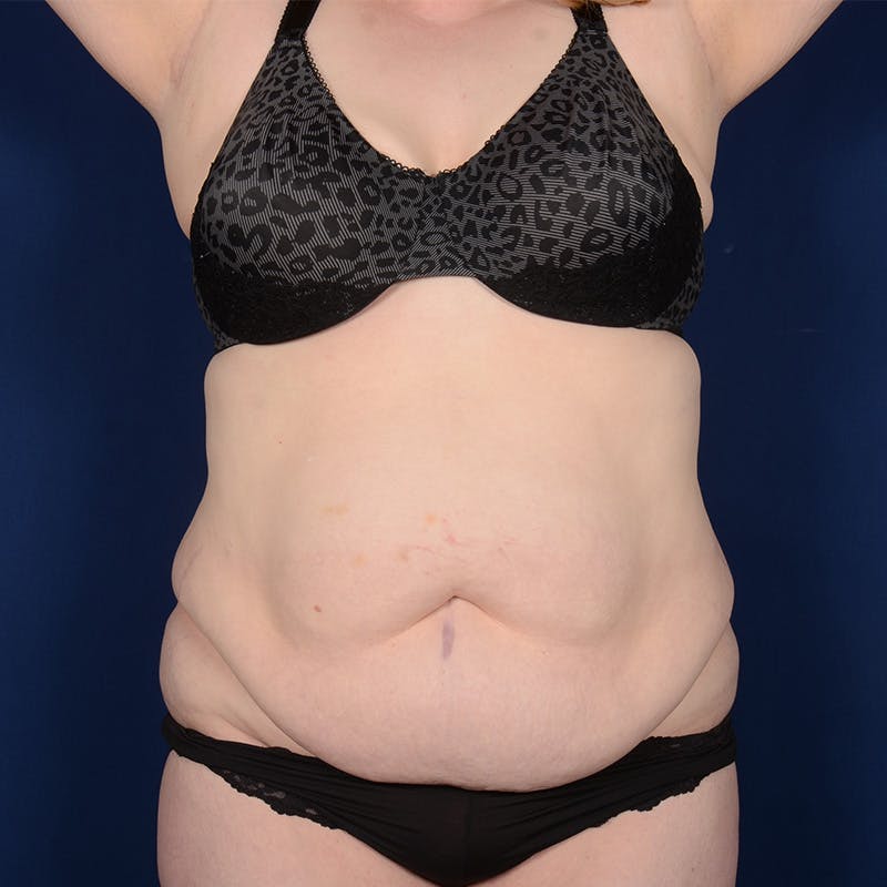 Tummy Tuck Before & After Gallery - Patient 173551 - Image 1