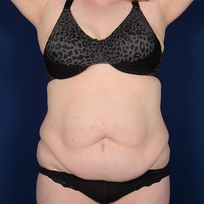 Tummy Tuck Before & After Gallery - Patient 173551 - Image 1