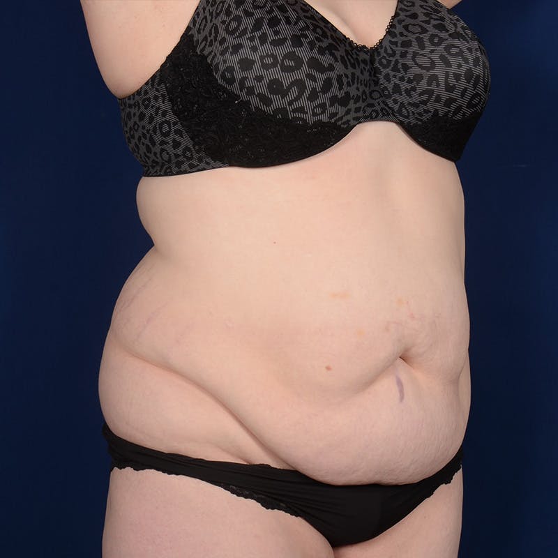 Tummy Tuck Before & After Gallery - Patient 173551 - Image 3
