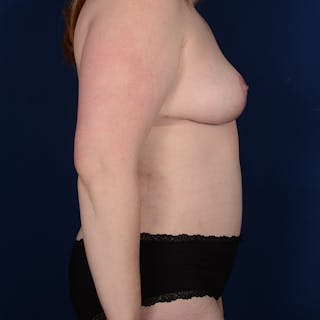 Tummy Tuck Before & After Gallery - Patient 173551 - Image 6