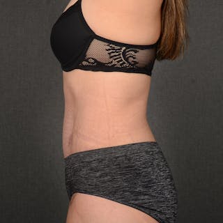 Tummy Tuck Before & After Gallery - Patient 231685 - Image 6