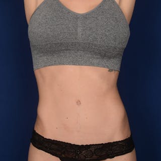 Severe Diastasis Recti Before & After Gallery - Patient 417101 - Image 2