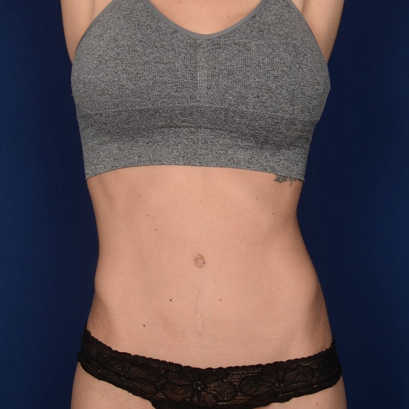Severe Diastasis Recti Before & After Gallery - Patient 417101 - Image 2