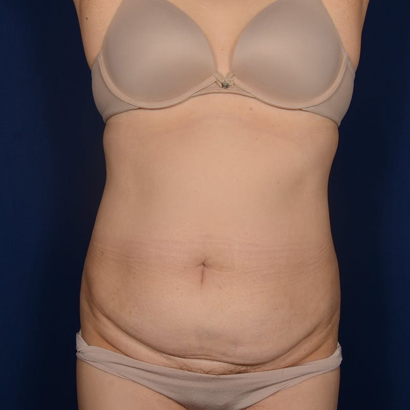 Tummy Tuck Before & After Gallery - Patient 562249 - Image 1