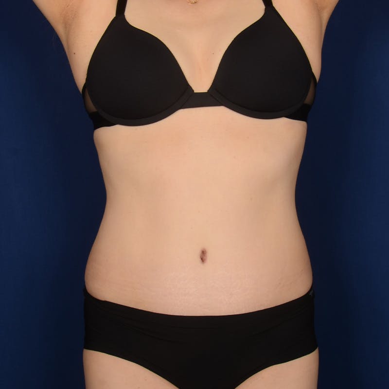 Tummy Tuck Before & After Gallery - Patient 562249 - Image 2