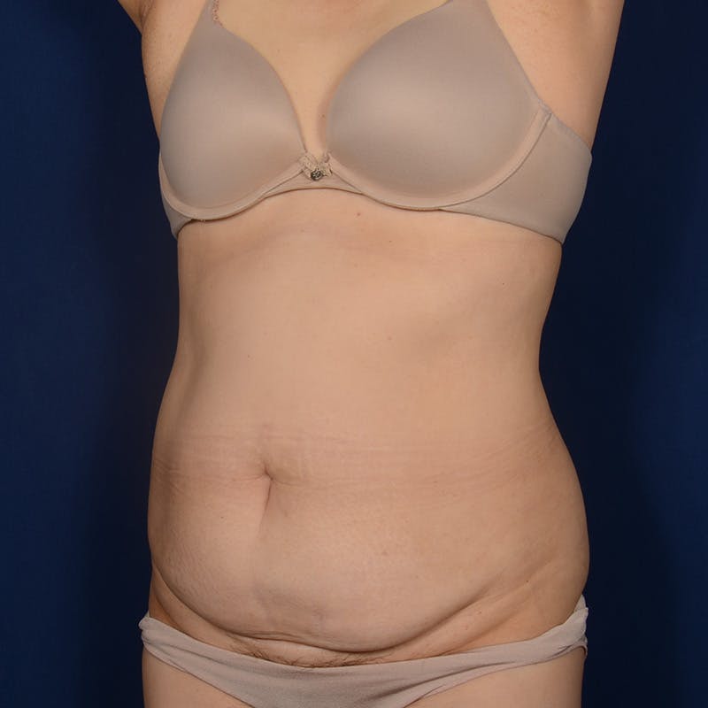 Tummy Tuck Before & After Gallery - Patient 562249 - Image 3