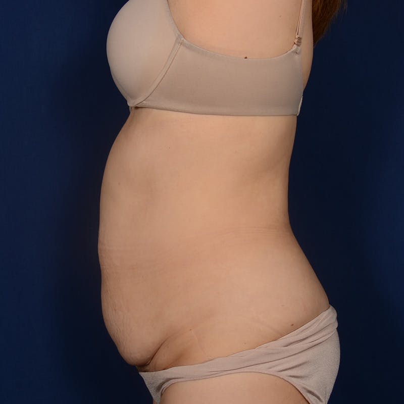 Tummy Tuck Before & After Gallery - Patient 562249 - Image 5