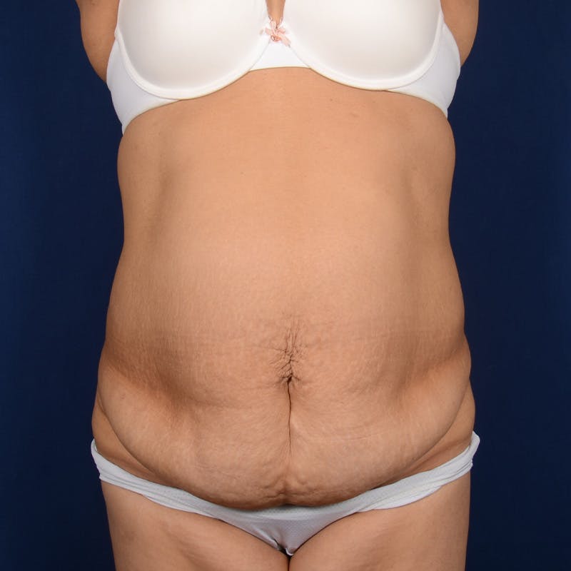 Tummy Tuck Before & After Gallery - Patient 270018 - Image 1