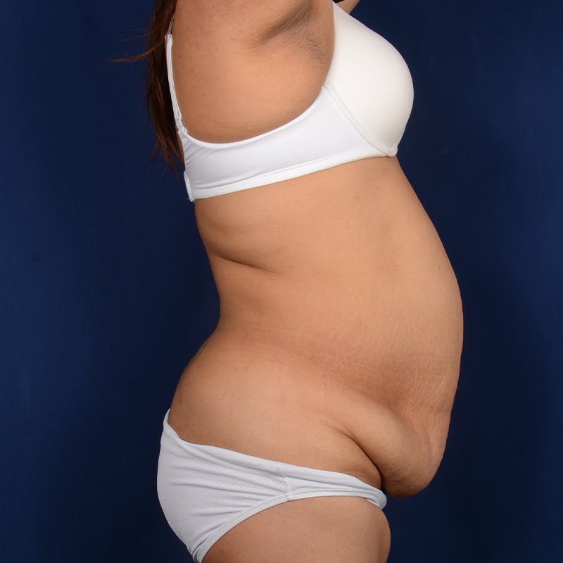 Tummy Tuck Before & After Gallery - Patient 270018 - Image 5