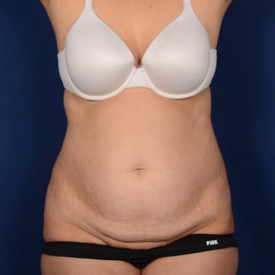 Tummy Tuck Before & After Gallery - Patient 109166 - Image 1