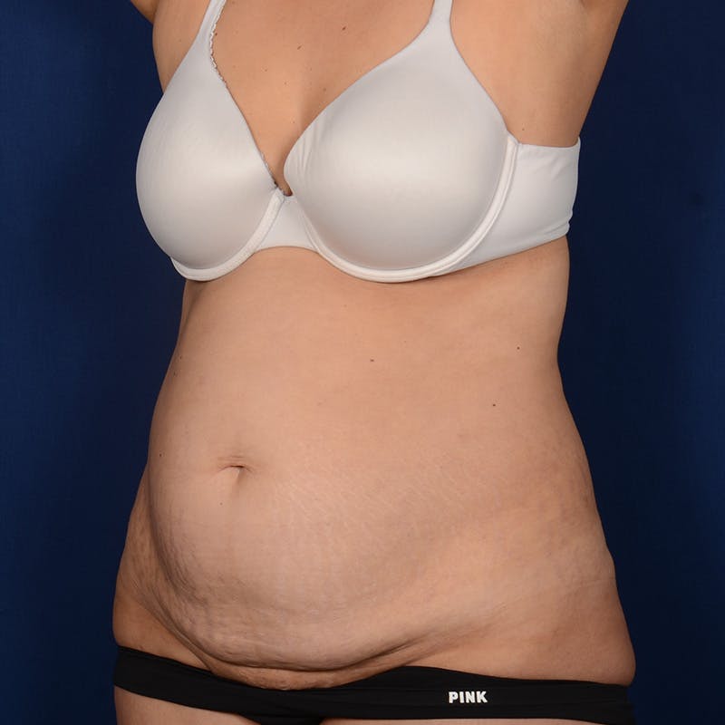 Severe Diastasis Recti Before & After Gallery - Patient 276679 - Image 3