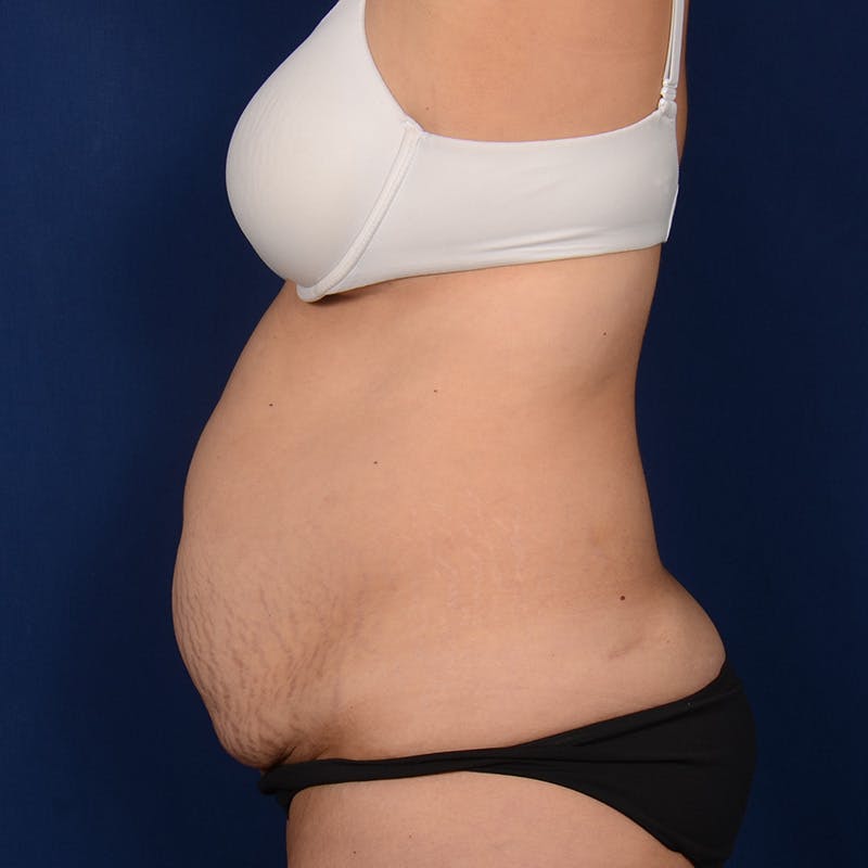 Severe Diastasis Recti Before & After Gallery - Patient 276679 - Image 5