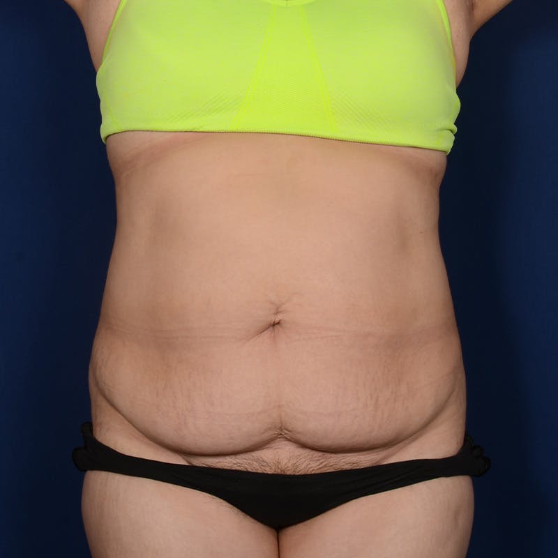 Tummy Tuck Before & After Gallery - Patient 279692 - Image 1