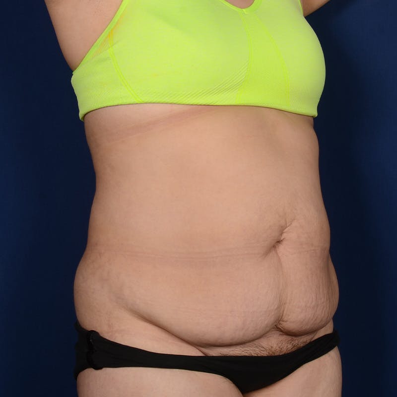 Tummy Tuck Before & After Gallery - Patient 279692 - Image 3