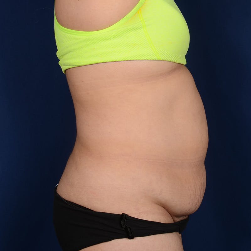 Tummy Tuck Before & After Gallery - Patient 279692 - Image 5
