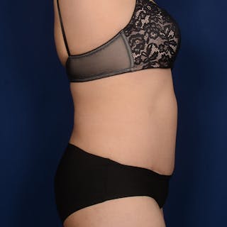 Tummy Tuck Before & After Gallery - Patient 279692 - Image 6