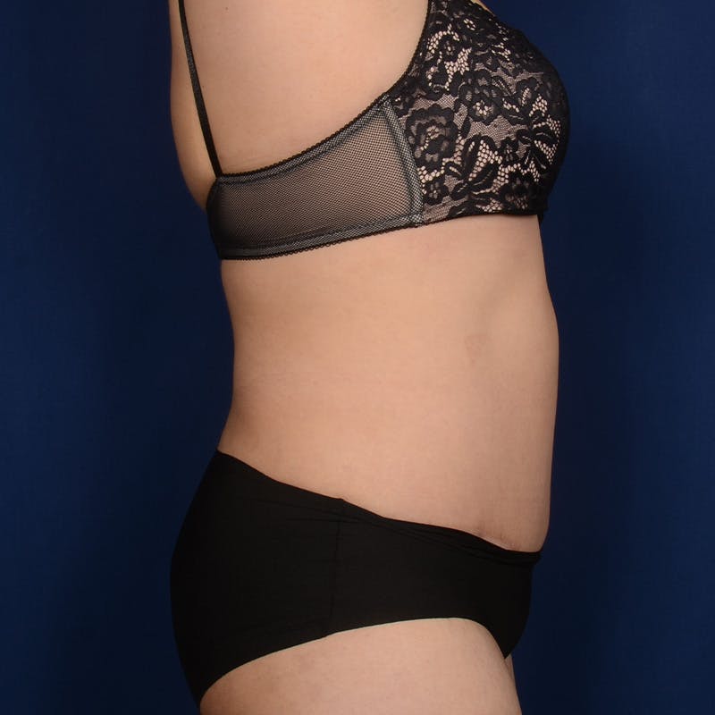 Tummy Tuck Before & After Gallery - Patient 279692 - Image 6