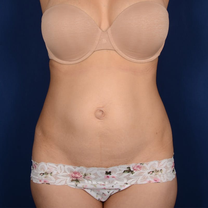 Tummy Tuck Before & After Gallery - Patient 120584 - Image 1