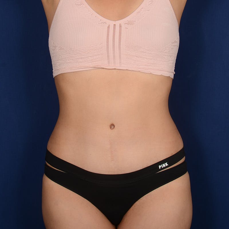 Tummy Tuck Before & After Gallery - Patient 120584 - Image 2