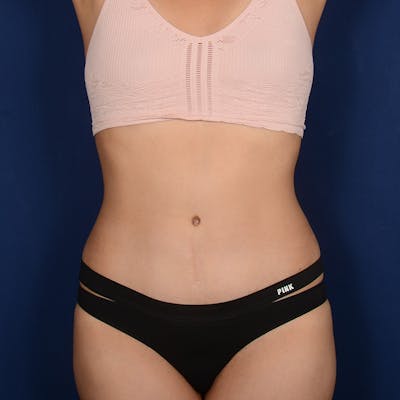 Tummy Tuck Before & After Gallery - Patient 120584 - Image 2
