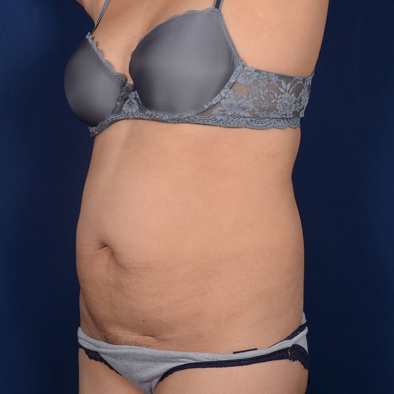 Tummy Tuck Before & After Gallery - Patient 399044 - Image 3
