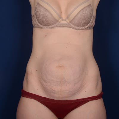Tummy Tuck Before & After Gallery - Patient 270920 - Image 1