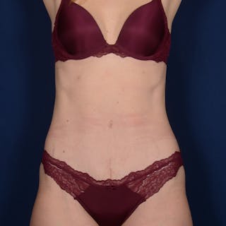Tummy Tuck Before & After Gallery - Patient 270920 - Image 2