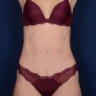 Tummy Tuck Before & After Gallery - Patient 270920 - Image 2