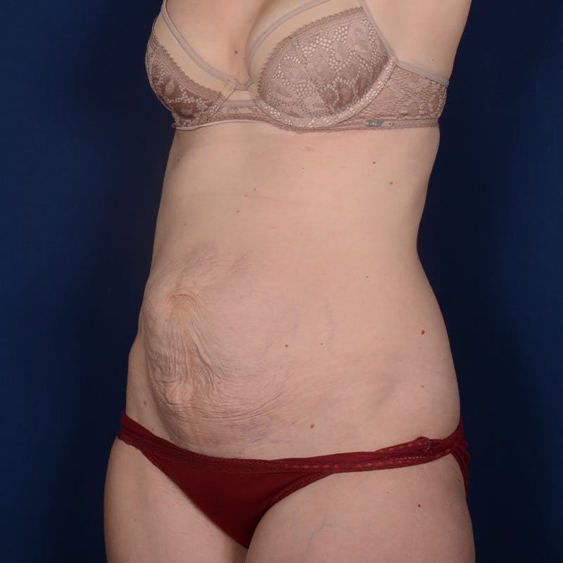 Tummy Tuck Before & After Gallery - Patient 270920 - Image 3