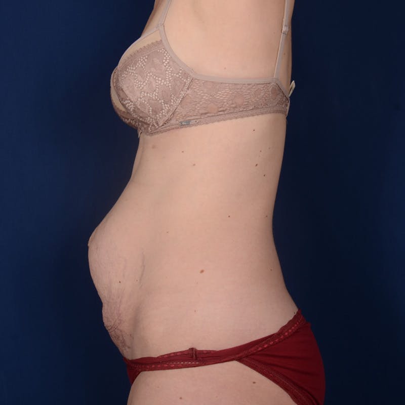 Tummy Tuck Before & After Gallery - Patient 270920 - Image 5