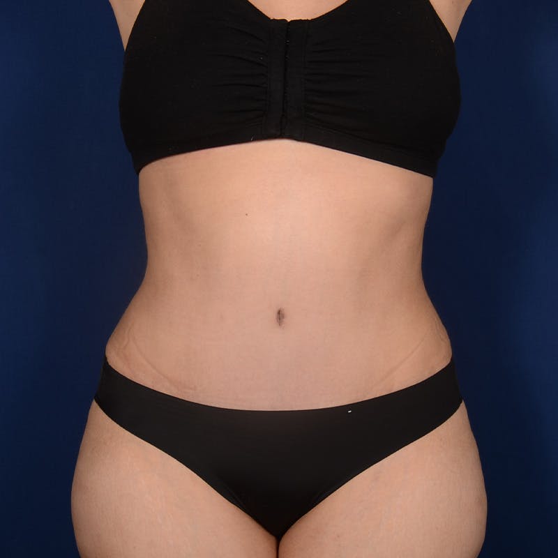 Tummy Tuck Before & After Gallery - Patient 633222 - Image 2