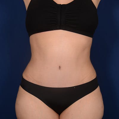 Tummy Tuck Before & After Gallery - Patient 633222 - Image 2