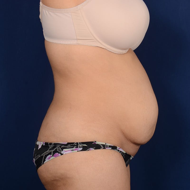 Tummy Tuck Before & After Gallery - Patient 633222 - Image 5
