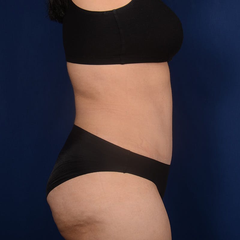 Tummy Tuck Before & After Gallery - Patient 633222 - Image 6