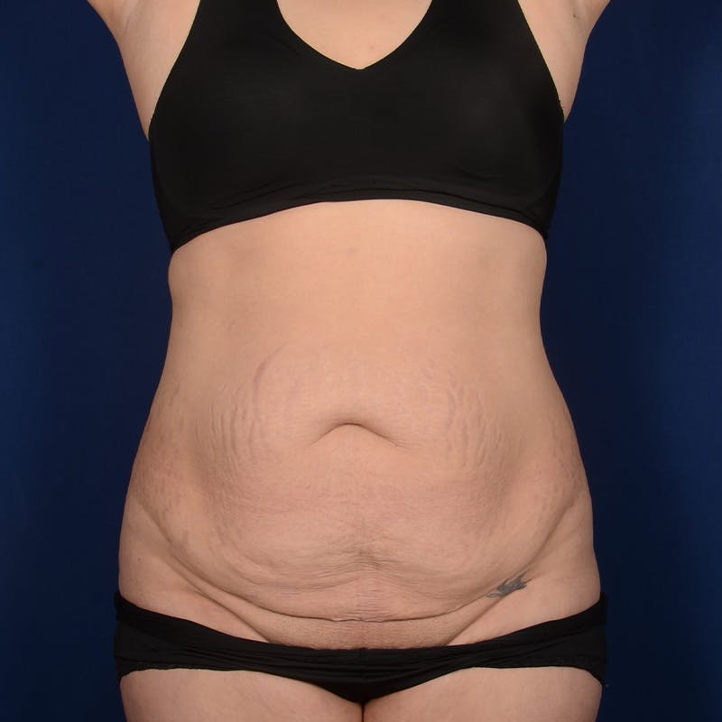 Tummy Tuck Before & After Gallery - Patient 199385 - Image 1