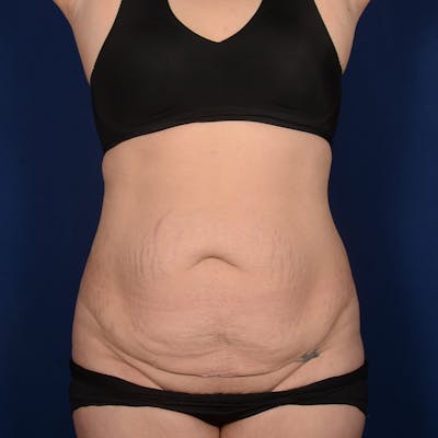 Tummy Tuck Before & After Gallery - Patient 199385 - Image 1