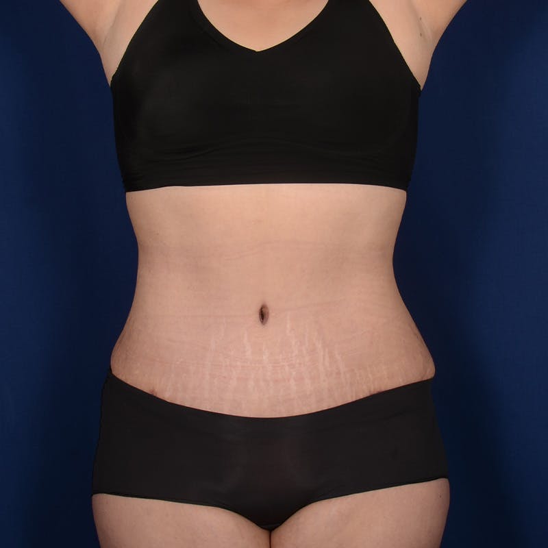 Tummy Tuck Before & After Gallery - Patient 199385 - Image 2