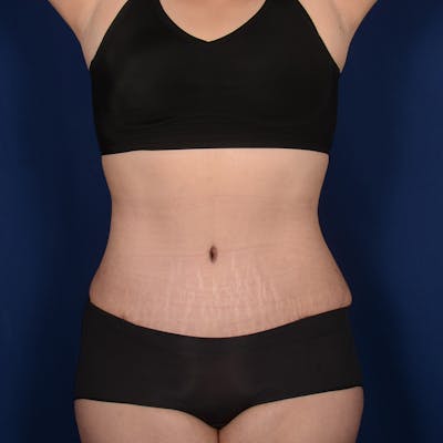 Tummy Tuck Before & After Gallery - Patient 199385 - Image 2
