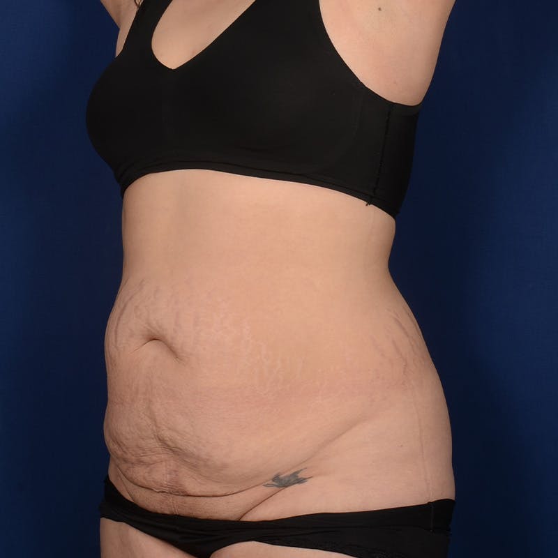 Tummy Tuck Before & After Gallery - Patient 199385 - Image 3