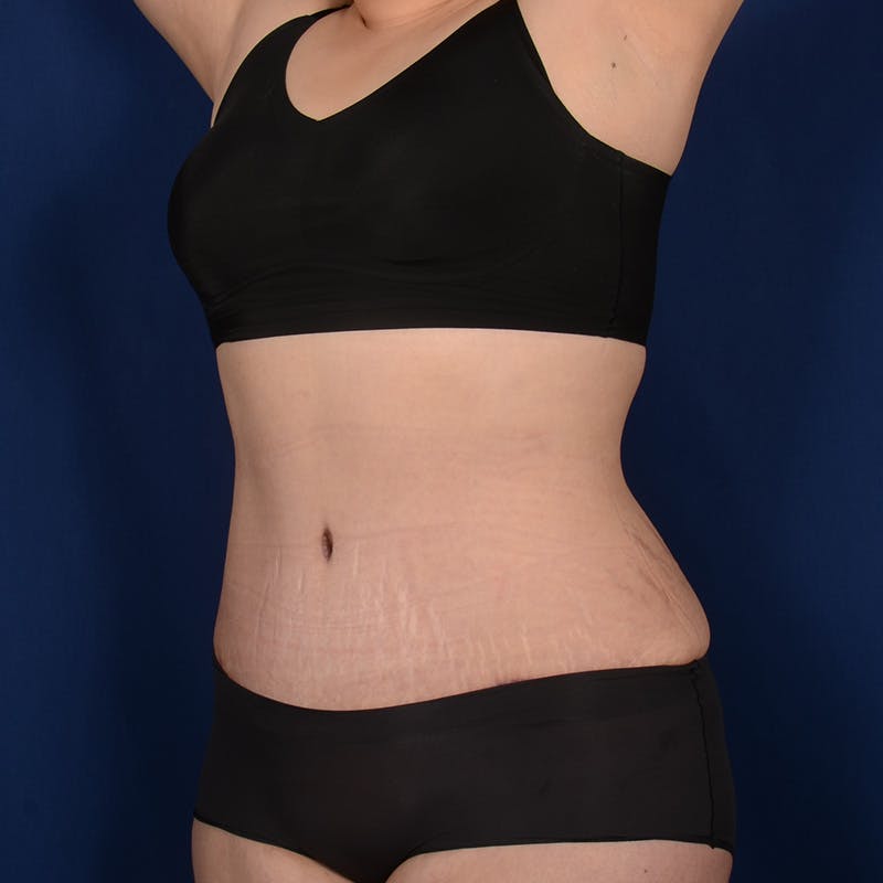 Tummy Tuck Before & After Gallery - Patient 199385 - Image 4