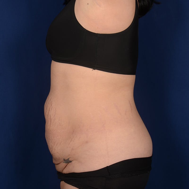 Tummy Tuck Before & After Gallery - Patient 199385 - Image 5
