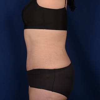 Tummy Tuck Before & After Gallery - Patient 199385 - Image 6